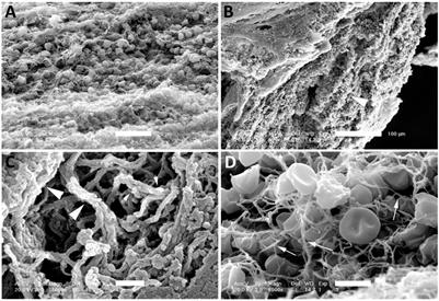 Netosis and Inflammasomes in Large Vessel Occlusion Thrombi